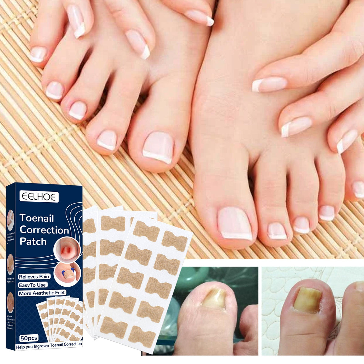 Nail Correction Patch, Nail Insert Correction And Repair Toe Manicure Nail Patch