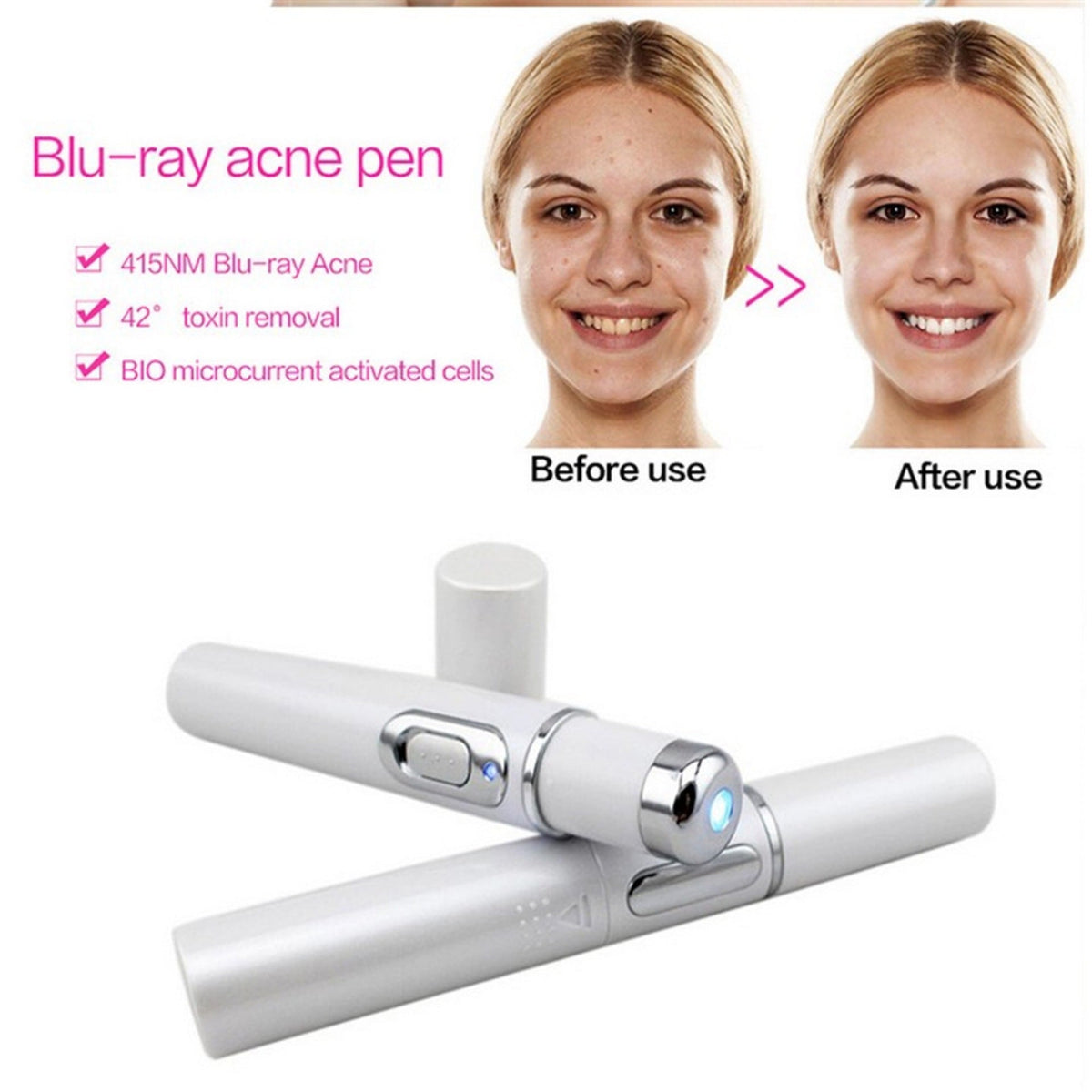 Blue Light Acne Laser Pen