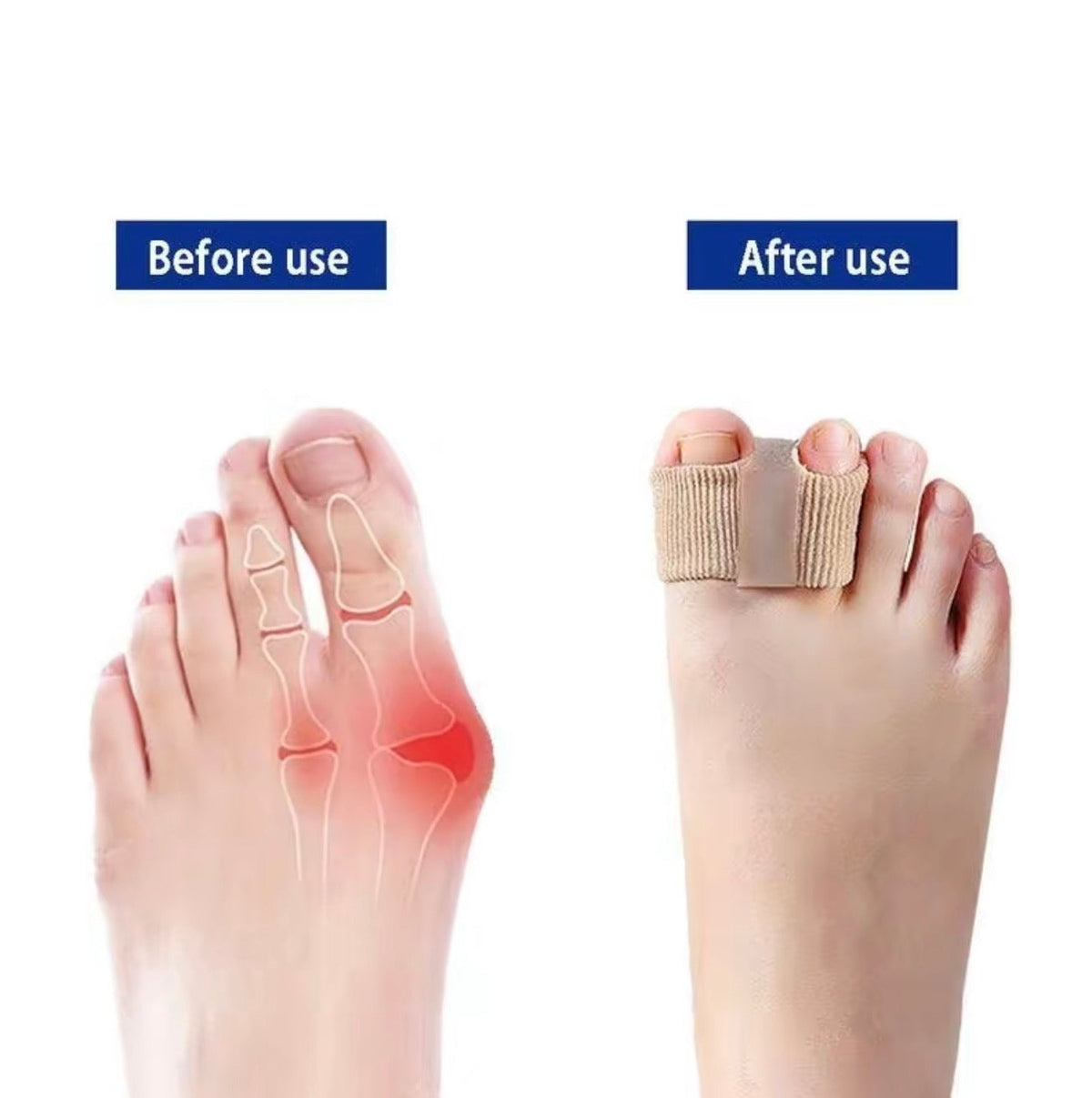 BunionEase Toe Separators