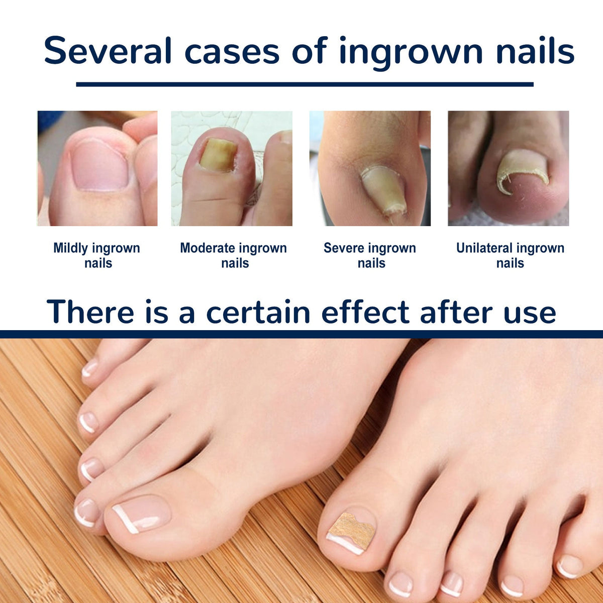 Nail Correction Patch, Nail Insert Correction And Repair Toe Manicure Nail Patch