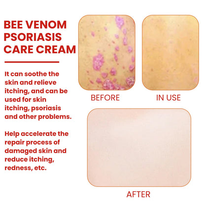 Bee-Poison Cowhide Moss Cream, Which Relieves Redness And Itchiness Of Skin